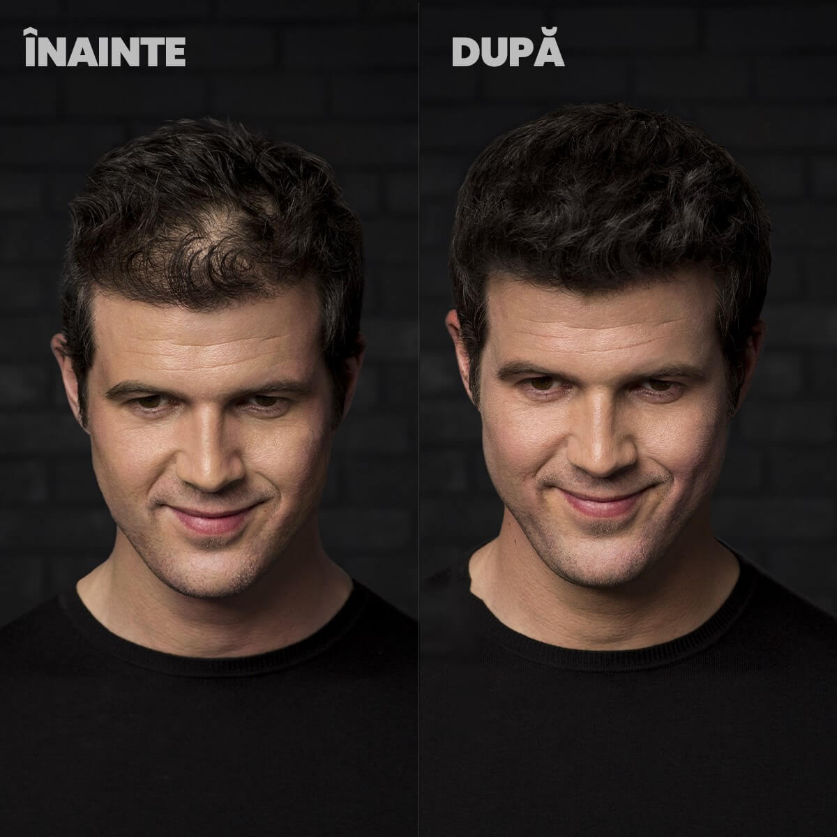 Nanofibre Toppik 12g + Fixativ Fiberhold = Păr vizibil mai des în câteva secunde – fără operații, fără trucuri!