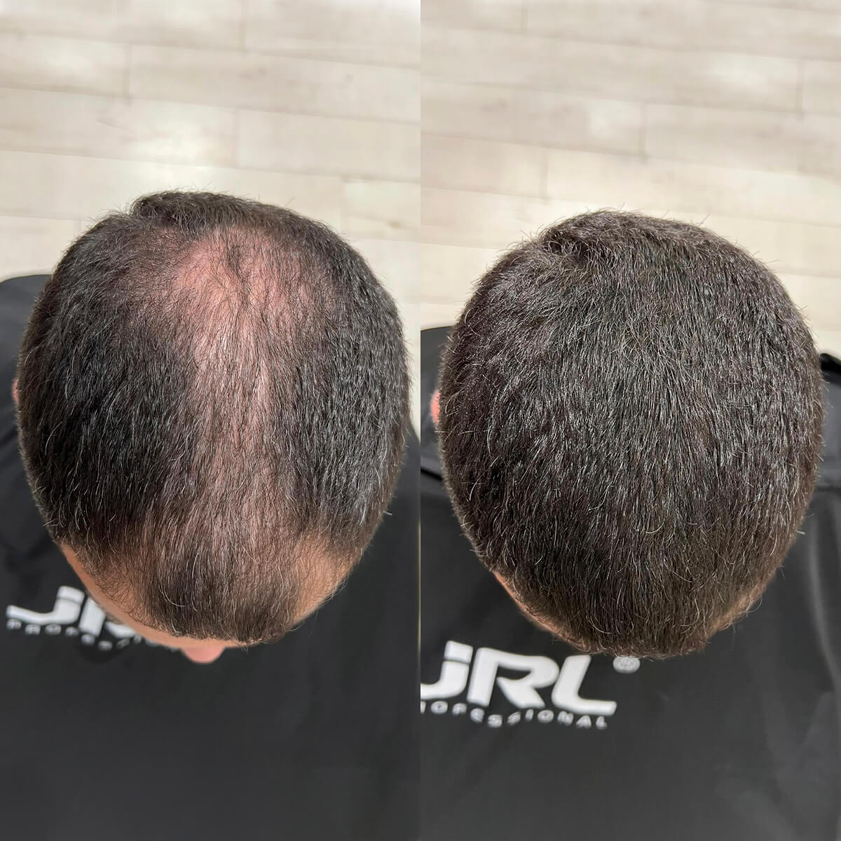 Nanofibre Toppik 12g + Fixativ Fiberhold = Păr vizibil mai des în câteva secunde – fără operații, fără trucuri!